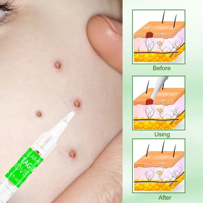 SKIN TAG REMOVER