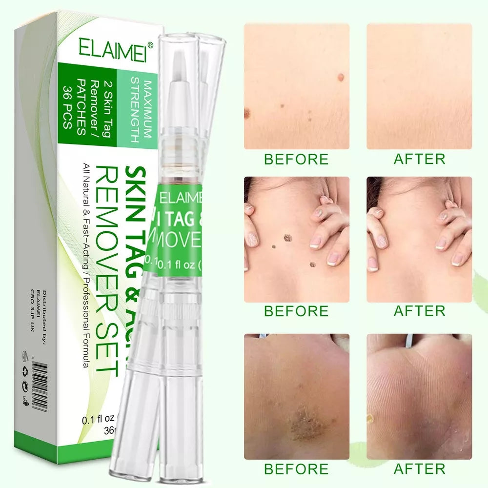 SKIN TAG REMOVER